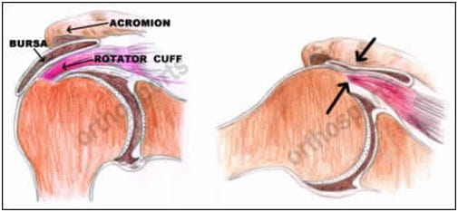 Shoulder Impingement