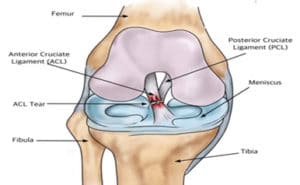 ACL surgery - to operate or not to operate? - Lively Physiotherapy