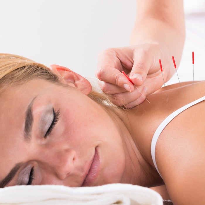 Acupuncture by Lively Physiotherapy & Pilates Studio